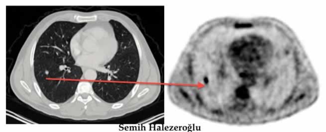 Pet Ct Sonucu Kac Gunde Cikar Sonucu Nasil Degerlendirilir