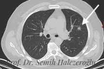 Akciğer kanseri teşhis ve tedavisi {{brizy_dc_image_alt imageSrc=