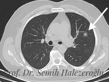 Akciğer kanseri hakkında